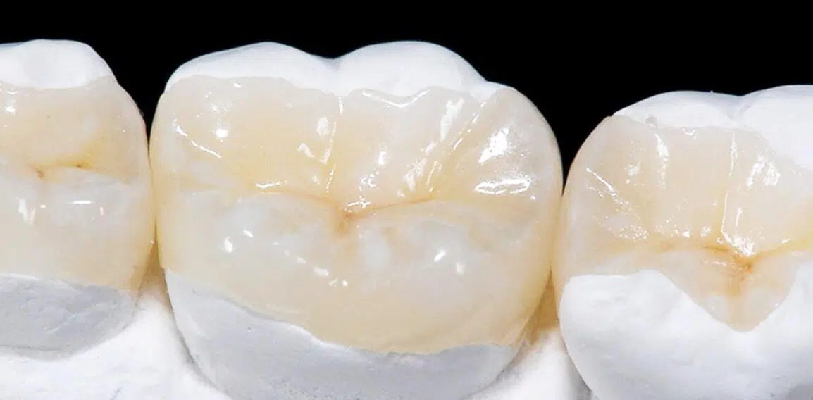 Soins prothétiques : traitements et tarifs | Dr Temstet | Paris 17