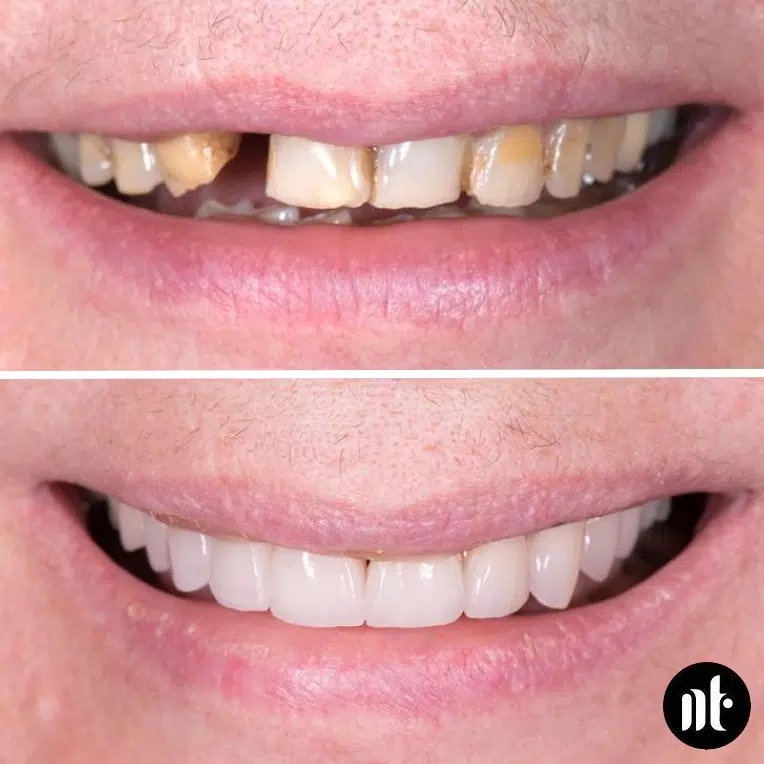 Facettes dentaires et greffe de gencive