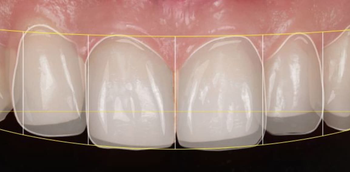 Digital Smile Design : esthétique du sourire | Dr Temstet | Paris 17