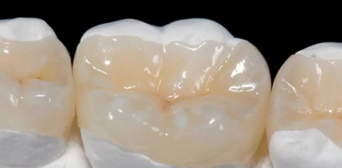 Inlay et Onlay : les prothèses dentaires | Dr Temstet | Paris