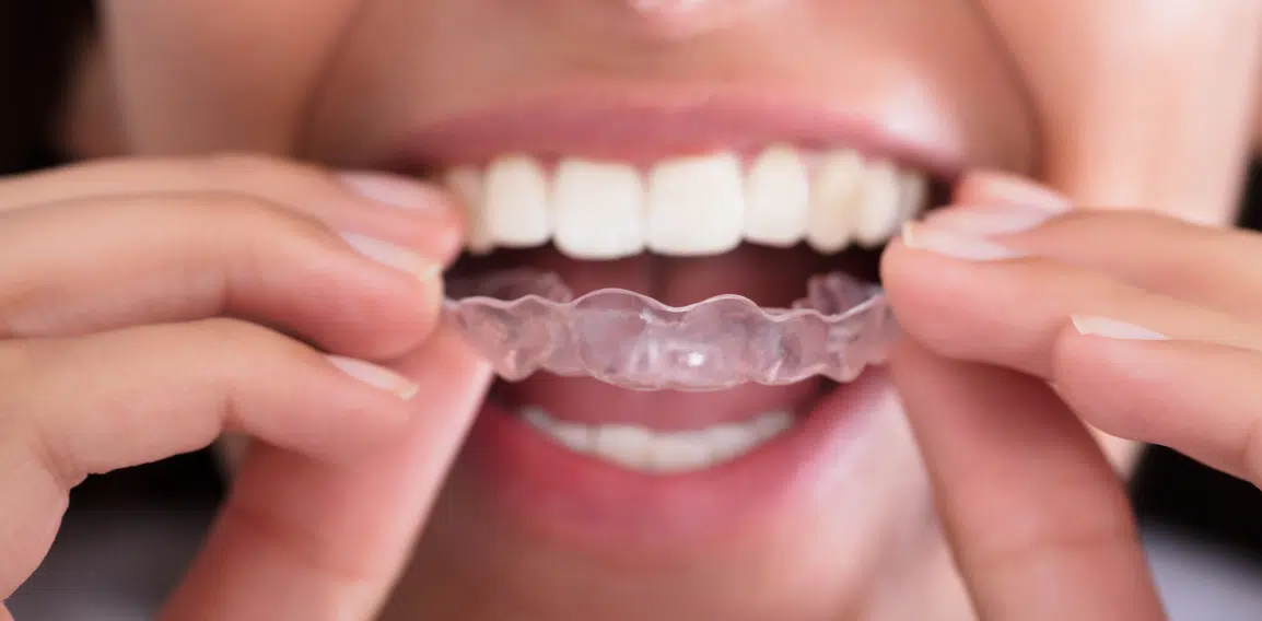 Invisalign : traitement d'orthodontie invisible | Dr Temstet | Paris 17