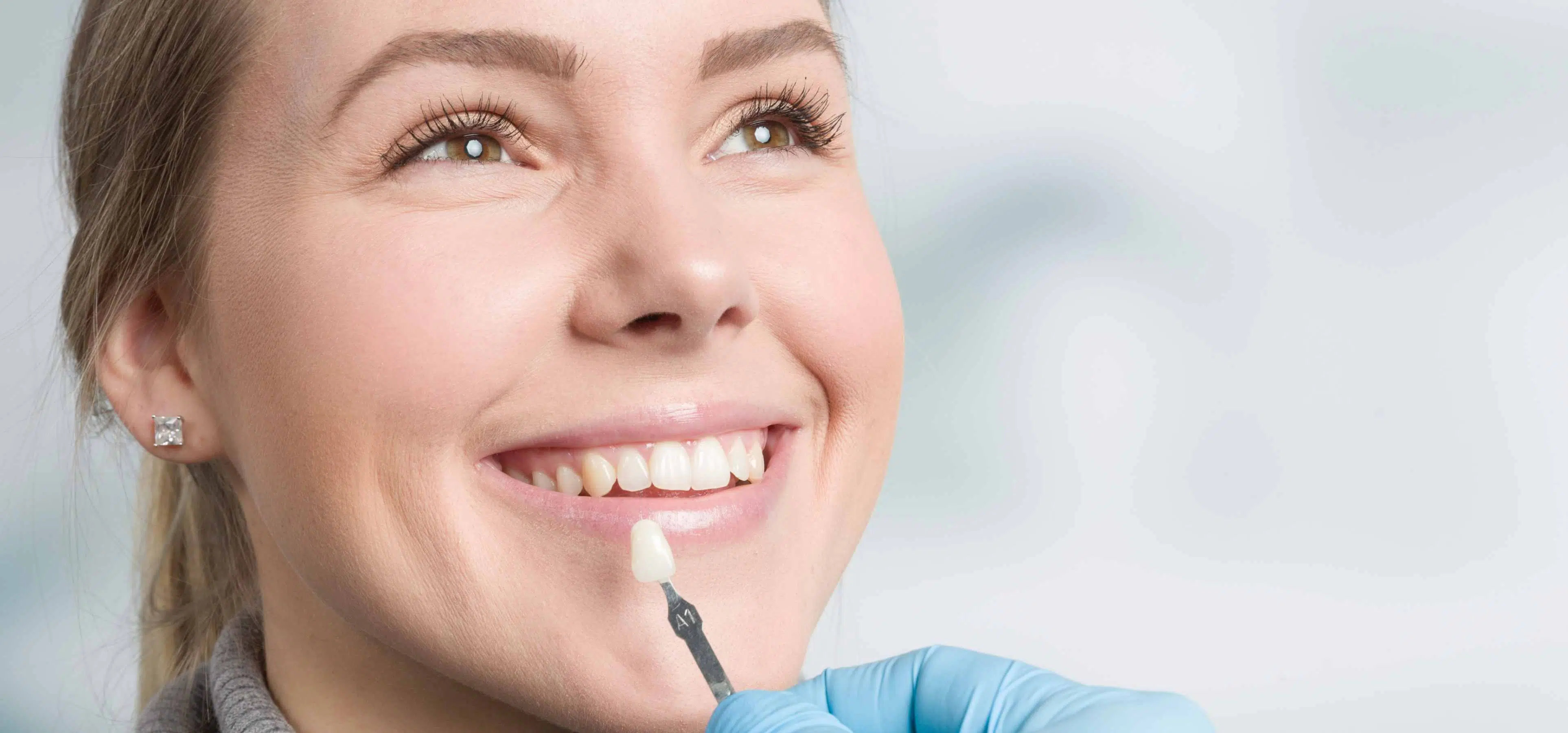 Facettes dentaires : quelle durée de vie ?| Dr Temstet| Paris