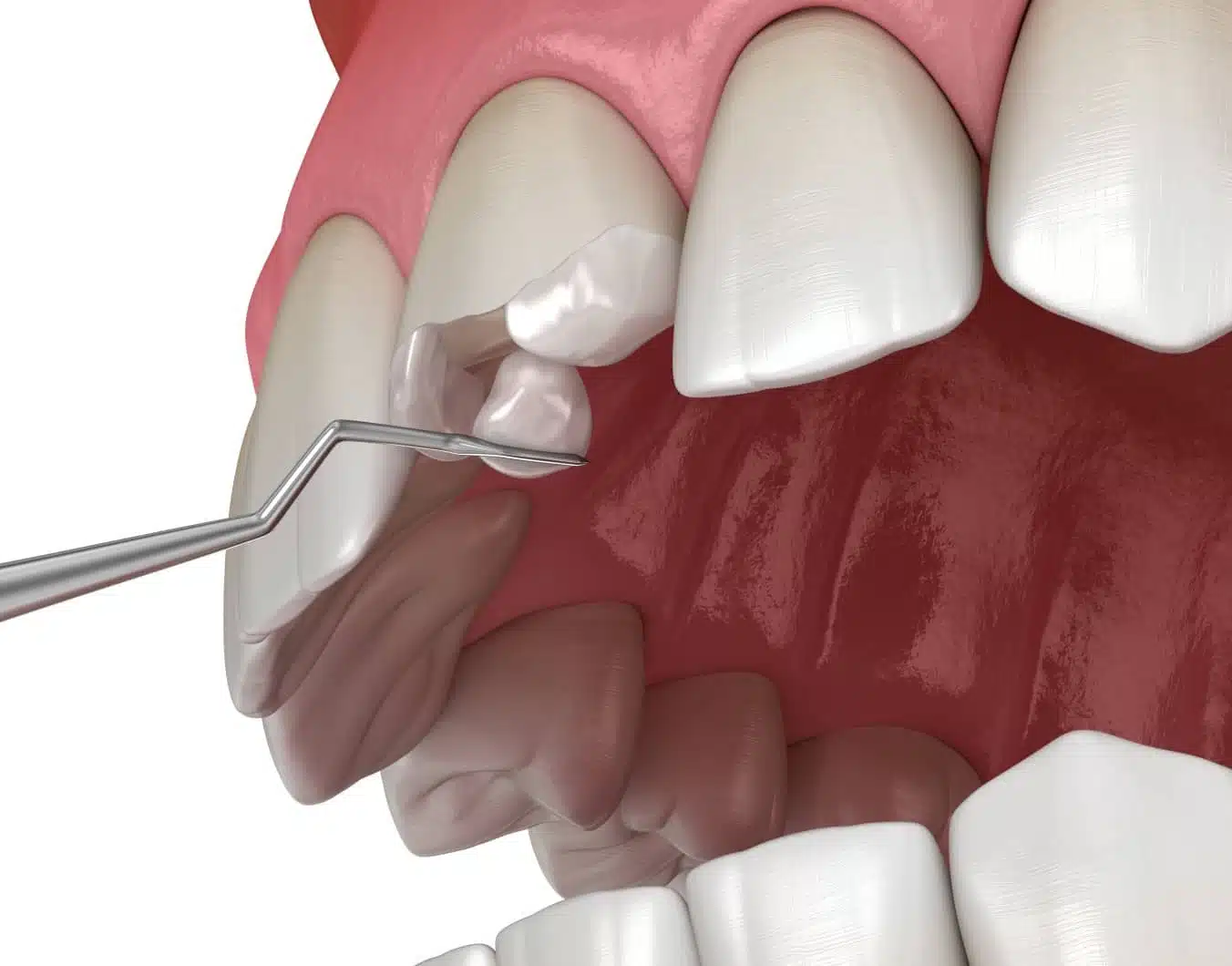 Peut-on réparer une dent cassée ? | Dr Temstet | Paris