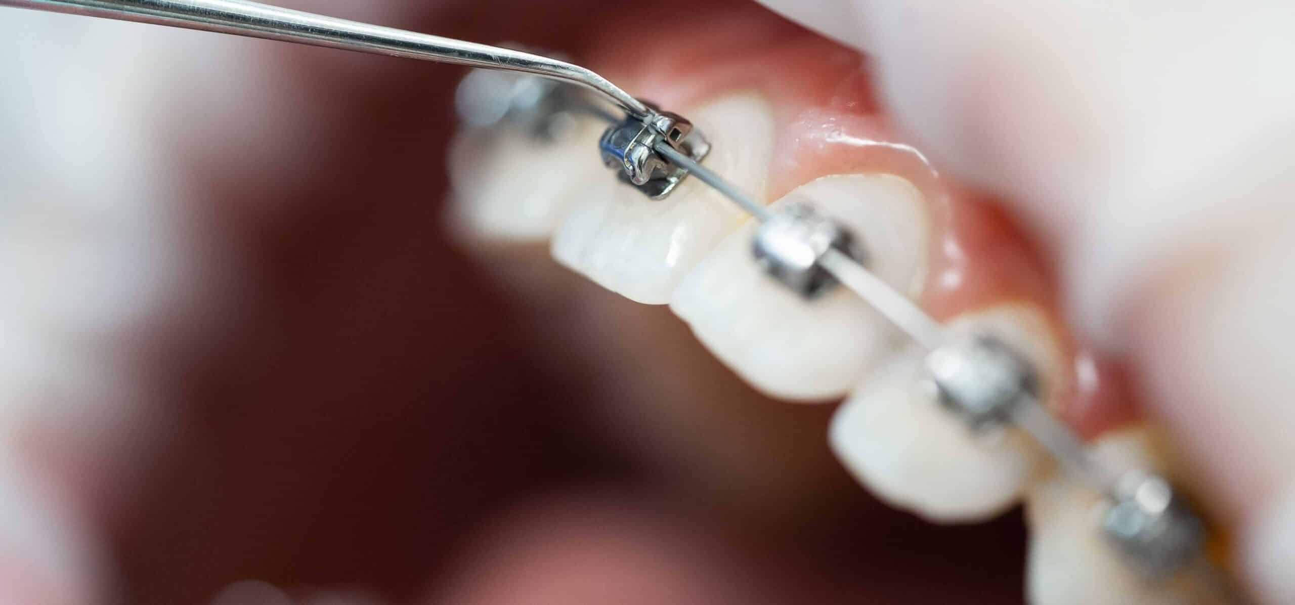 Les bénéfices d’un traitement orthodontique sur la santé bucco-dentaire | Dr Temstet | Paris