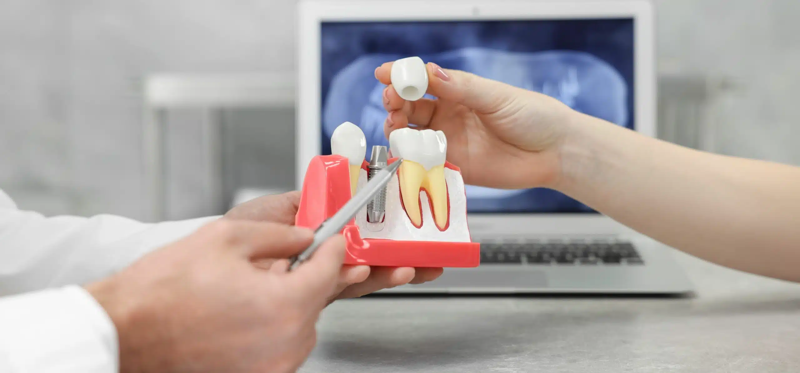 Est-il possible de remplacer ses plombages par des prothèses dentaires inlay onlay ? | Dr Temstet | Paris