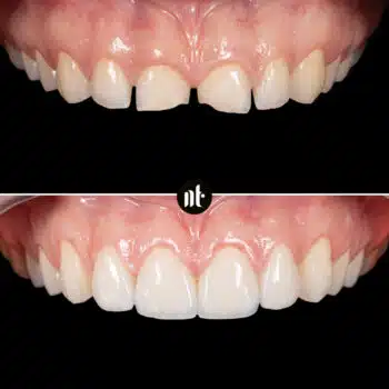 Facettes dentaires et traitement des gencives | Dr Temstet | Paris