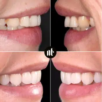 Facettes dentaires | Dr Temstet | Paris