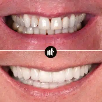 Facettes dentaires et traitement parodontie | Dr Temstet | Paris