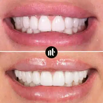 Reprise des facettes et des couronnes | Dr Temstet | Paris