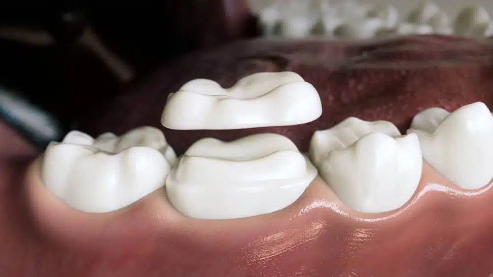 pose inlay onlay dr temstet paris