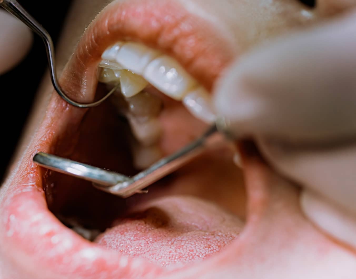 Pourquoi faire une greffe osseuse dentaire ? | Dr Temstet | Paris