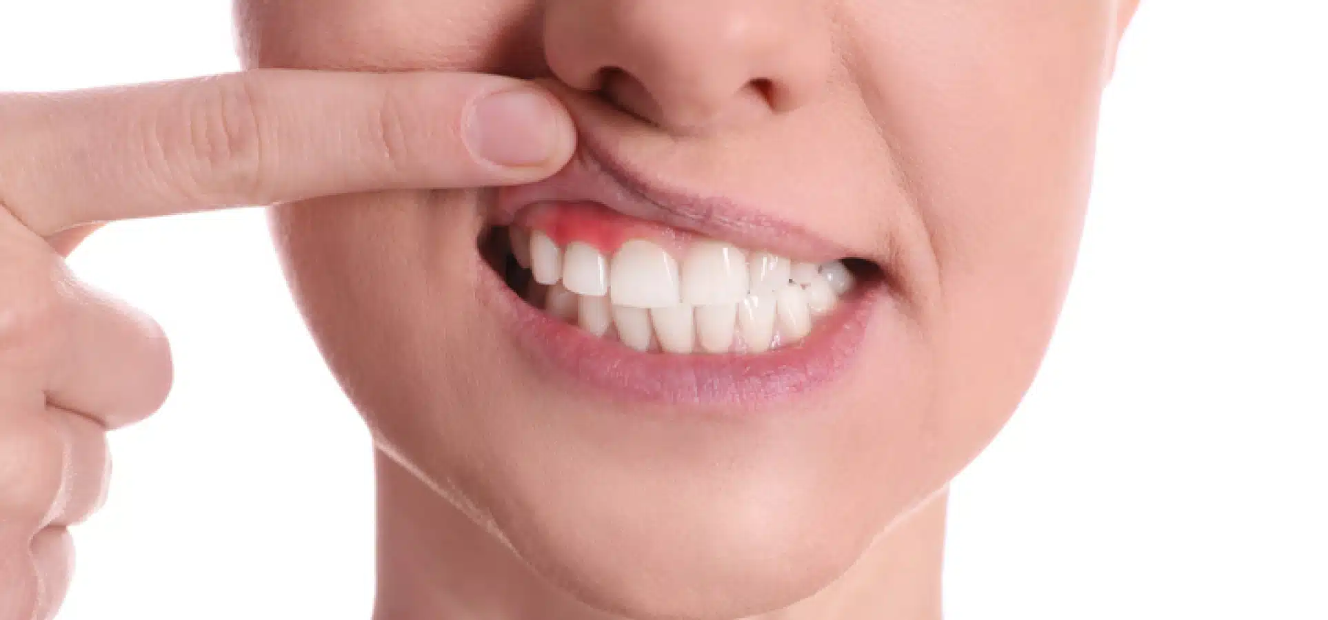 Comment repérer une gingivite ? | Dr Temstet | Paris