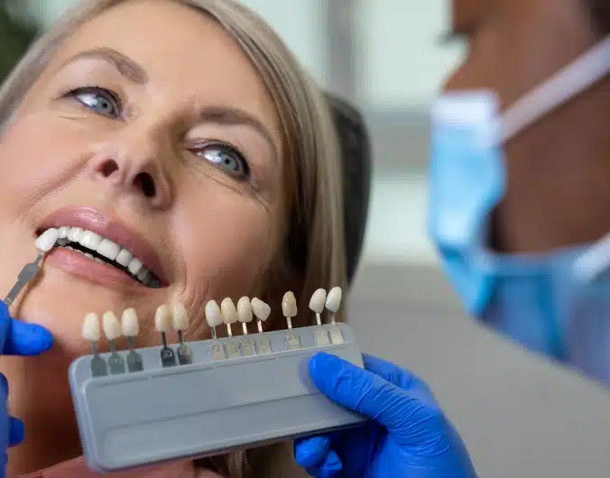Facettes dentaires : et apres ? | Dr Temstet | Paris