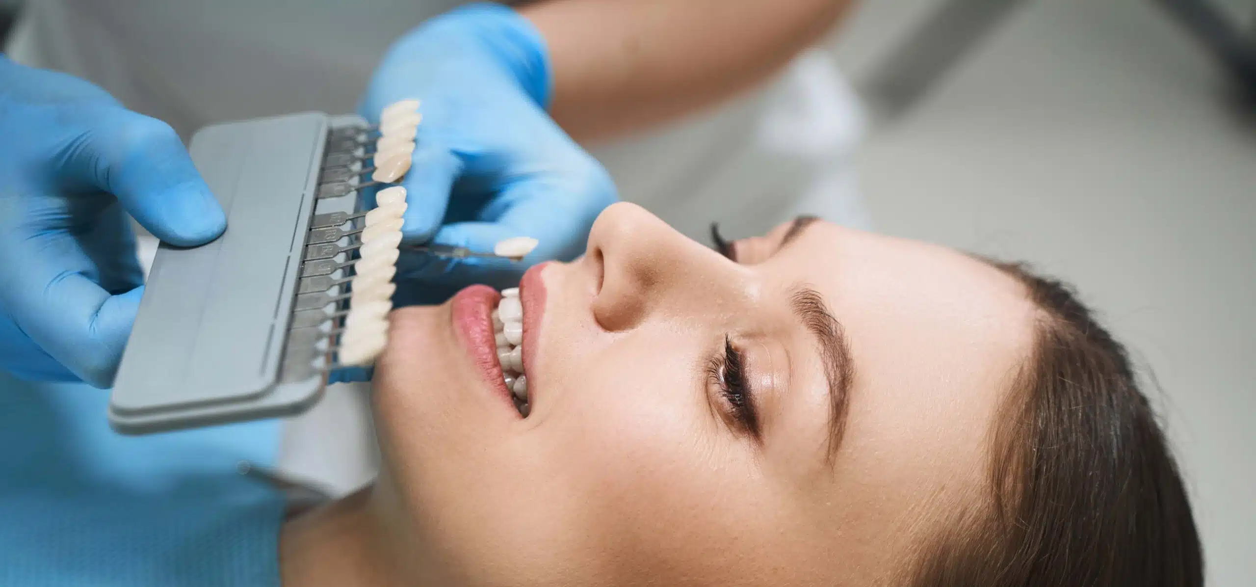 Les résultats des facettes dentaires avec le Dr Temstet à Paris