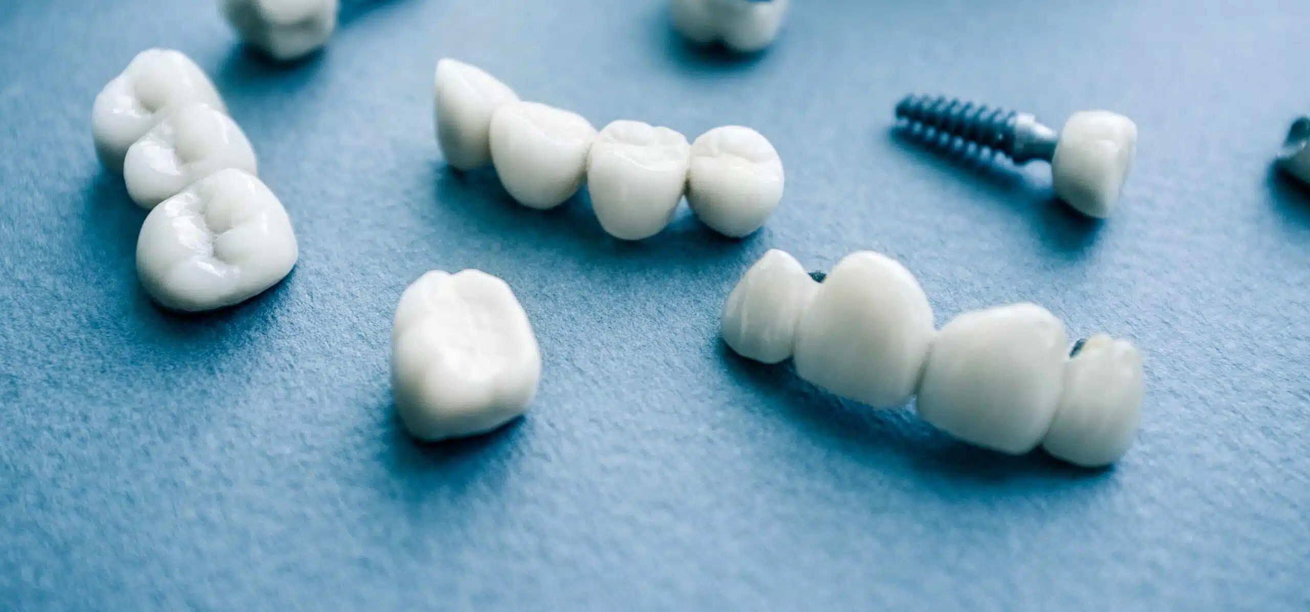 Comment remplacer plusieurs dents avec le Dr Temstet à Paris