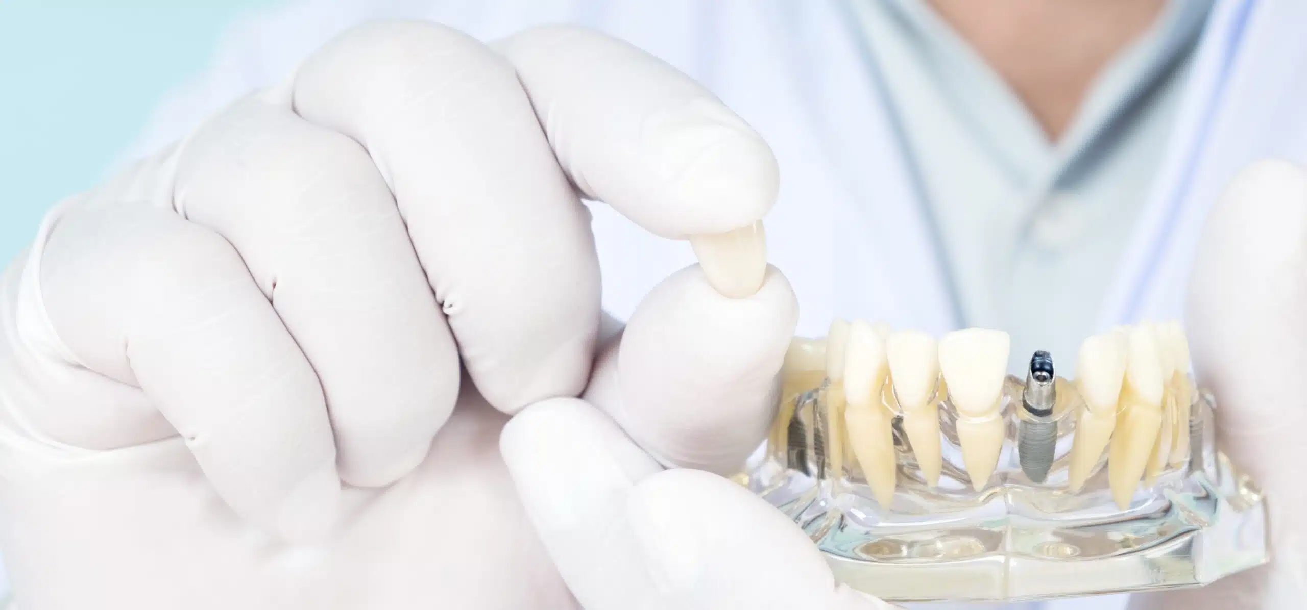 Implants dentaire ou bridge : que choisir ? Dr Temstet | Paris