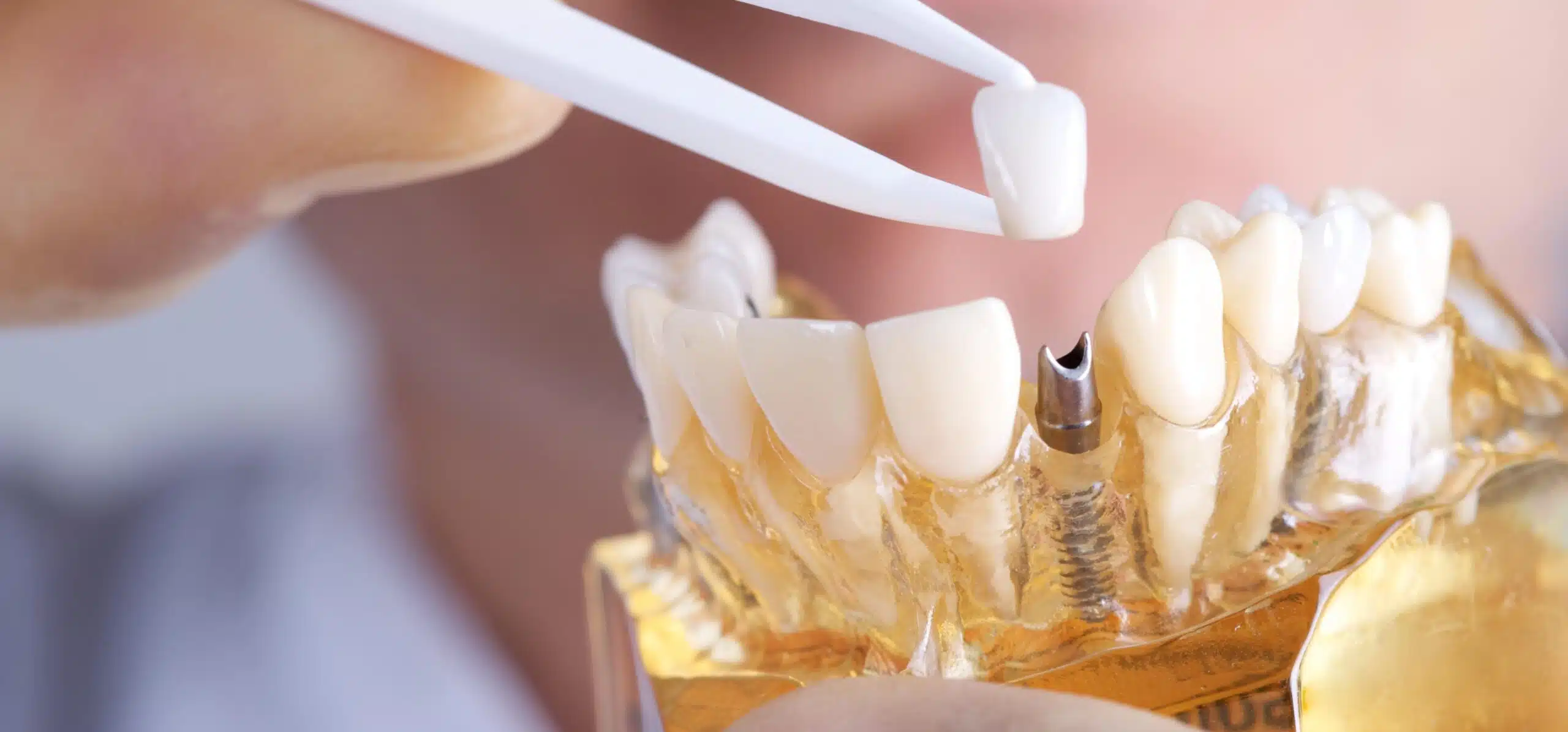 Facettes dentaires VS autres solutions : que choisir ? Dr Temstet | Paris