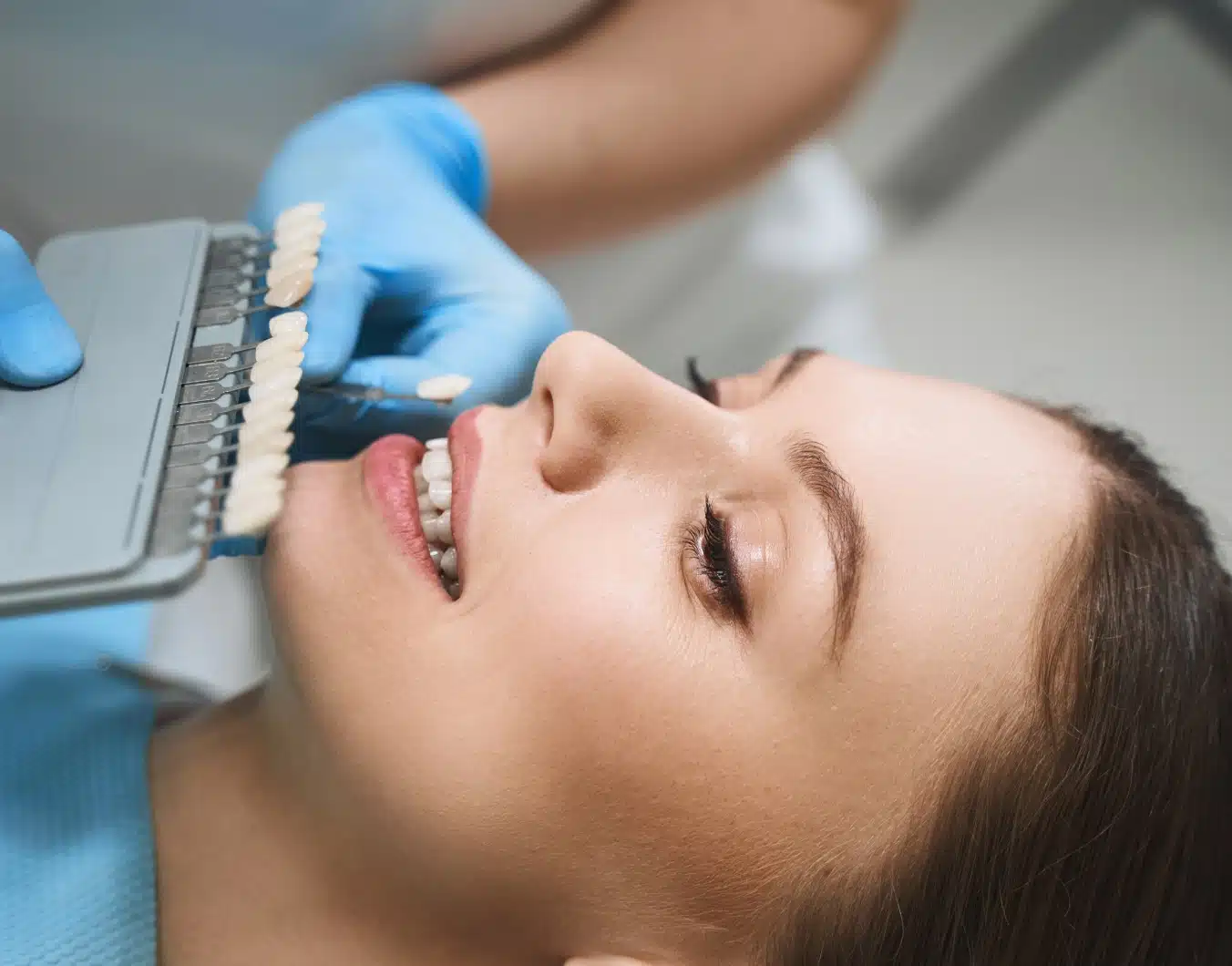 Les résultats des facettes dentaires avec le Dr Temstet à Paris