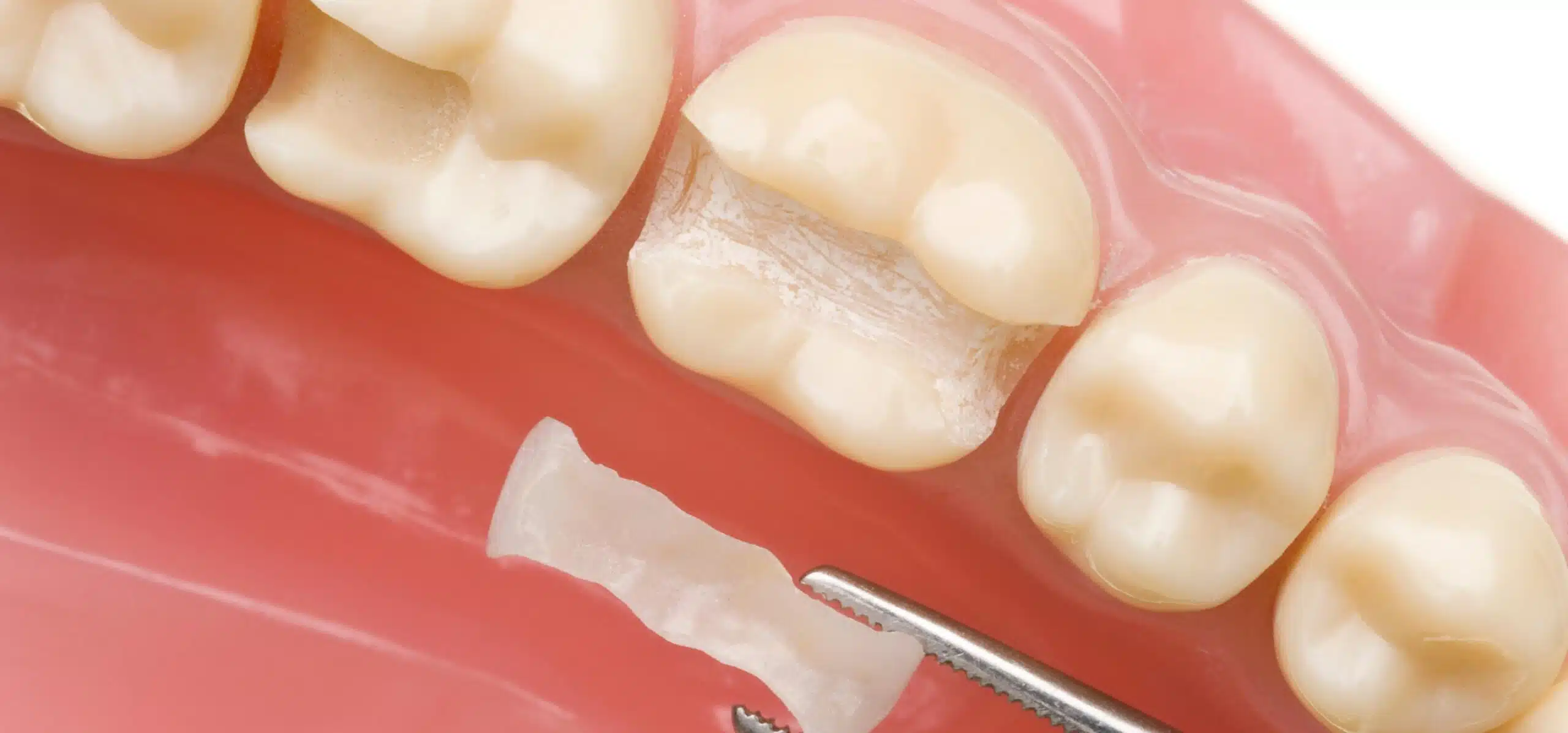 La pose d’onlay dentaire avec le Dr Temstet, dentiste spécialisé à Paris