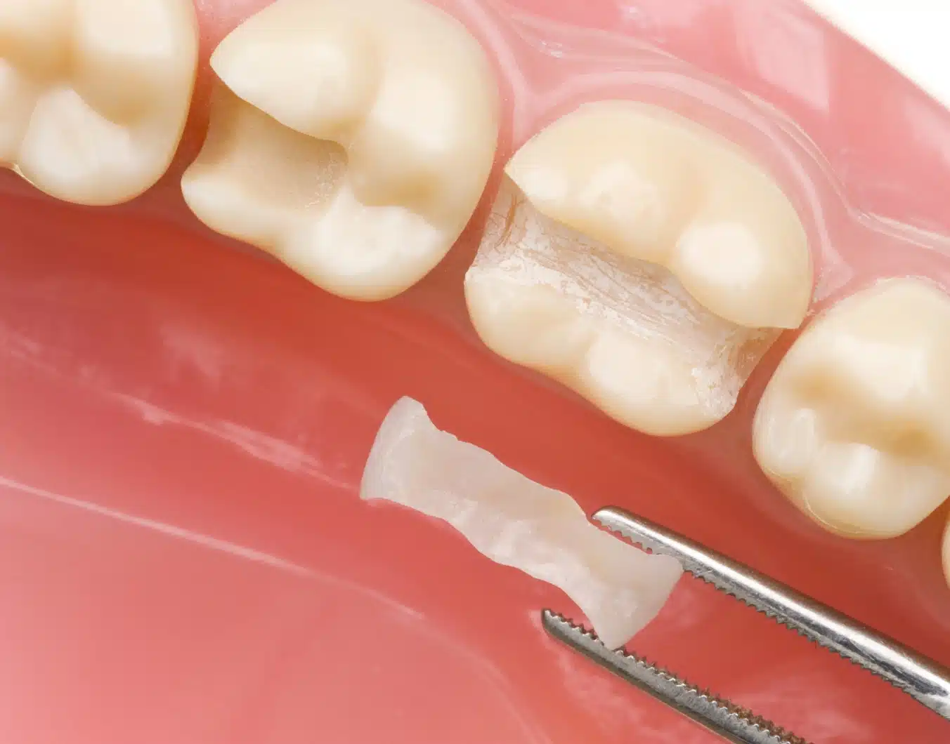 La pose d’onlay dentaire avec le Dr Temstet, dentiste spécialisé à Paris