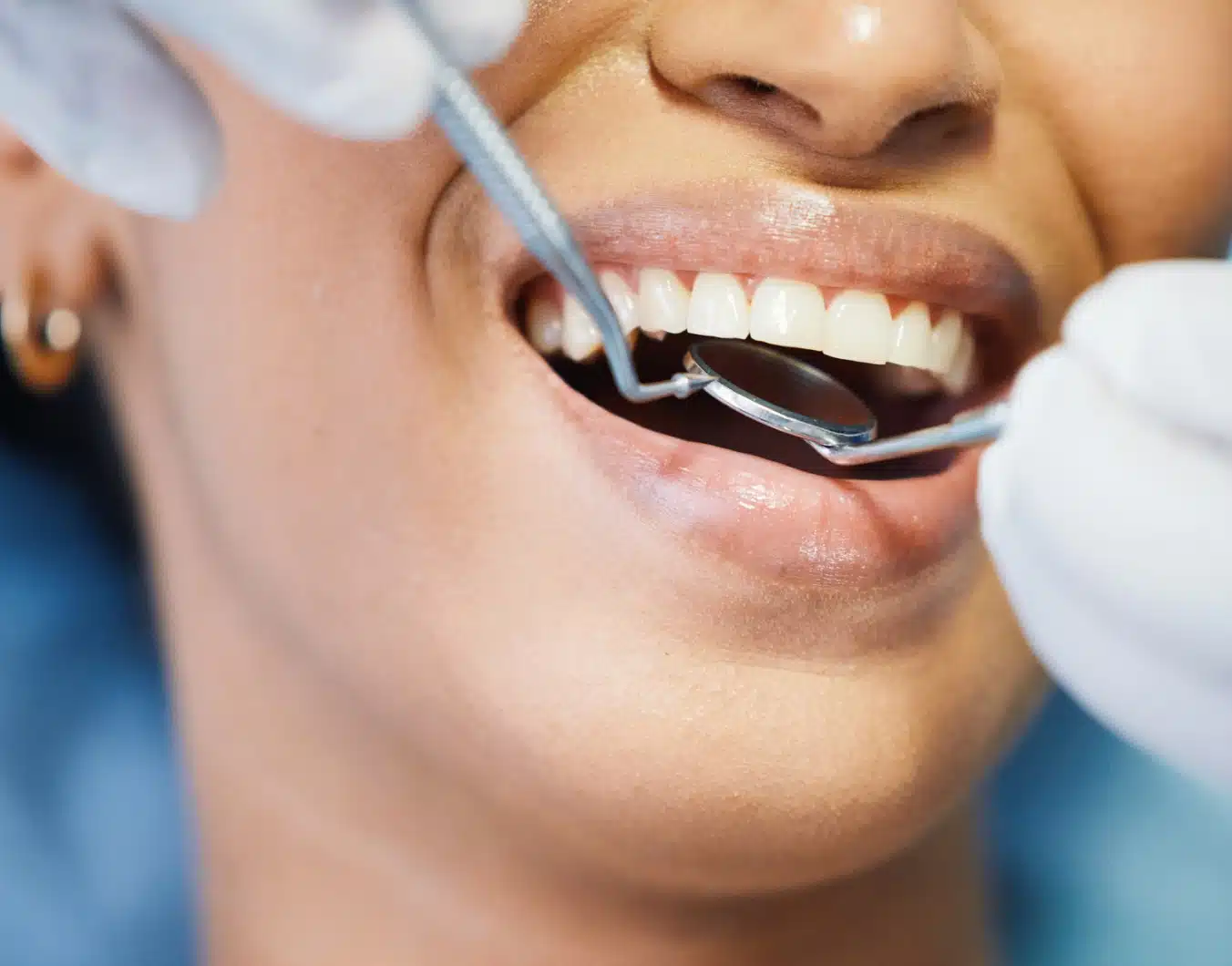 Dent dévitalisée et pose de couronne avec le Dr Temstet, dentiste spécialisé à Paris