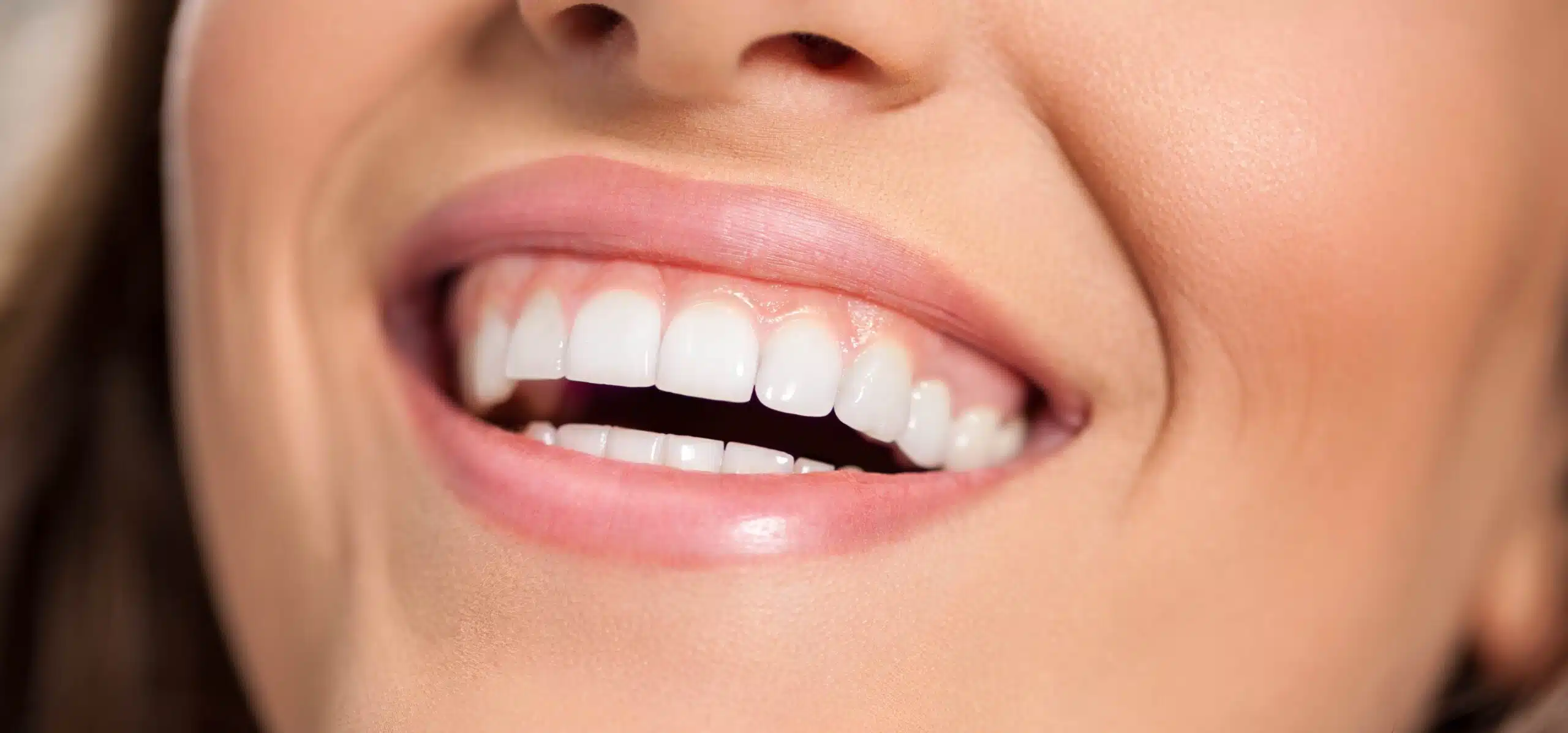 Facettes dentaire abîment dents